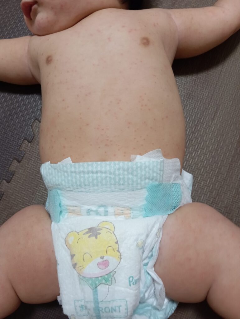 湿疹のでた赤ちゃんのおなか